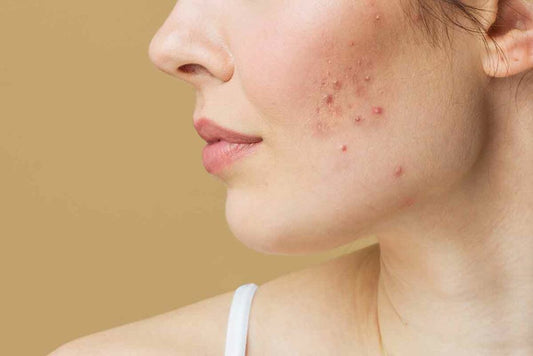 7 Most Effective and Natural Ways to Treat Acne: Your Path to Clearer Skin