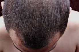 can_dandruff_cause_hair_loss