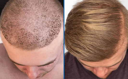 latest-technology-hair-restoration