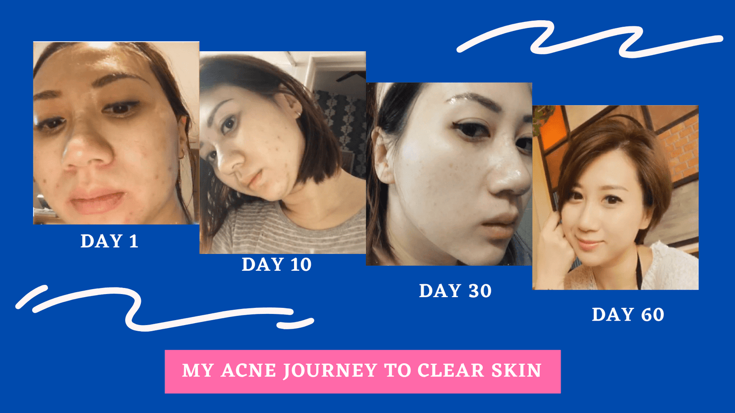 Alexis Pure Toco-Liftonin ARB Extra Strength Face Serum For Acne, Acne Scars, Minimize Pores, Oily/Greasy Skin, Skin Brightening, Improve Skin Barrier, Moisturize Skin – 30ml